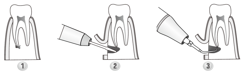 Сфера применения наконечника для скалера